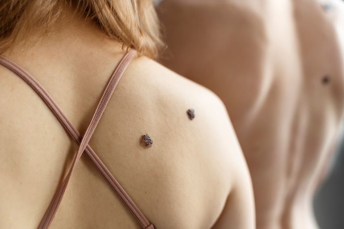Melanoma_Freepik Odos vėžys Lietuvoje kasmet paliečia 400 gyventojų. Kaip sumažinti riziką ir kas dažniausiai lemia gydymo sėkmę