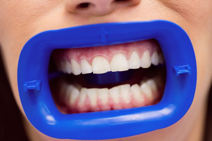 dantys_Freepik_patient_receiving_dental_treatment 3 dantų balinimo namuose mitai: ne tik pažeidžia emalį, bet ir didina apsinuodijimo riziką