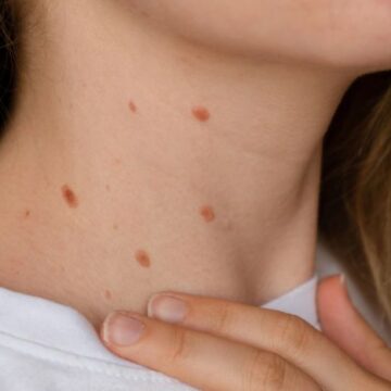 papilomoas_salinimas_httpsdepositphotos.comphotounrecognizable-woman-showing-her-birthmarks-neck-skin-close-detail-bare-640557680.html Ar papilomos pavojingos ir kada jas verta parodyti dermatologui?
